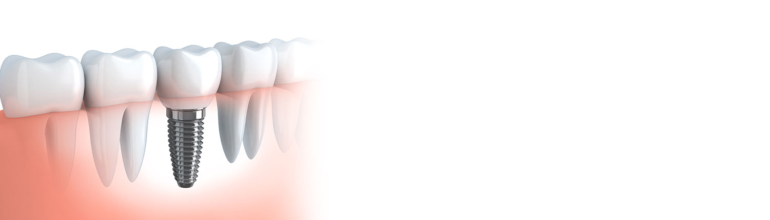 Dental Implants Near Mambourin